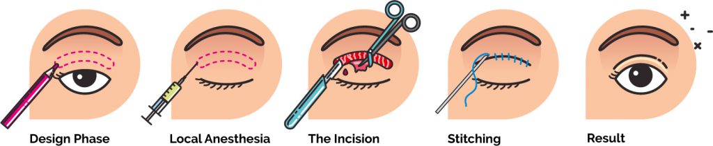 upper eyelid surgery inforgraphic