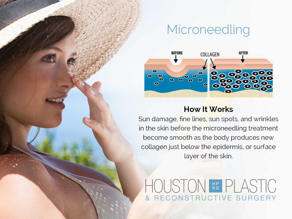Microneedling can be used to treat sun damaged skin