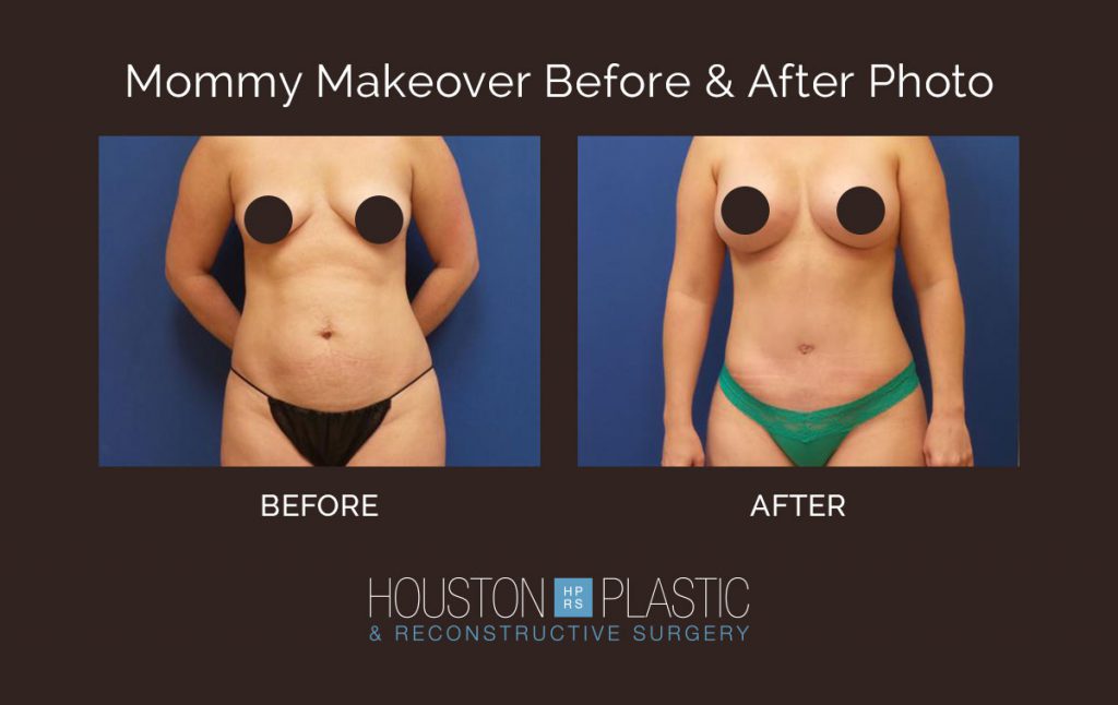 See more mommy makeover before and after photos
