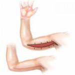 Arm Lift Incision Location