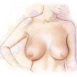 Breast Reduction Size Illustration
