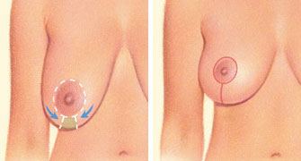 Lollipop incision graphic