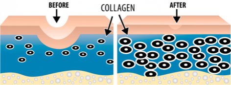 collagen induction therapy before and after