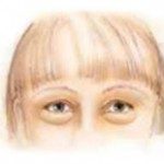 Eyelid Surgery Illustration