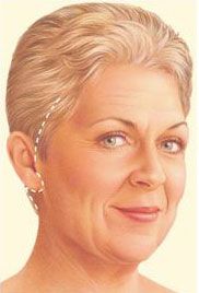 traditional facelift illustration