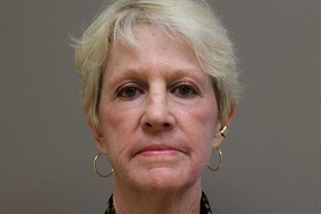 72 year old laser skin resurfacing after image