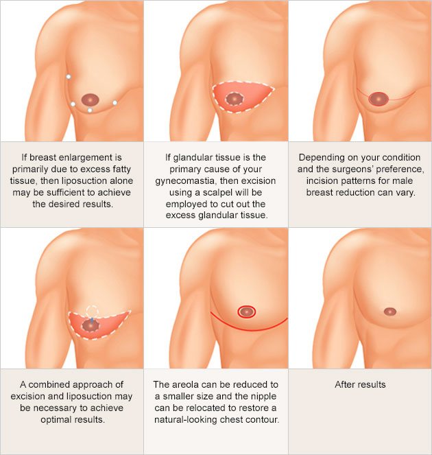 Male breast reduction graphic