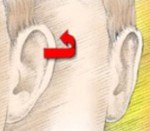 Ear Reshaping