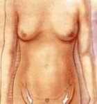 downward progressive tension tummy tuck illustration