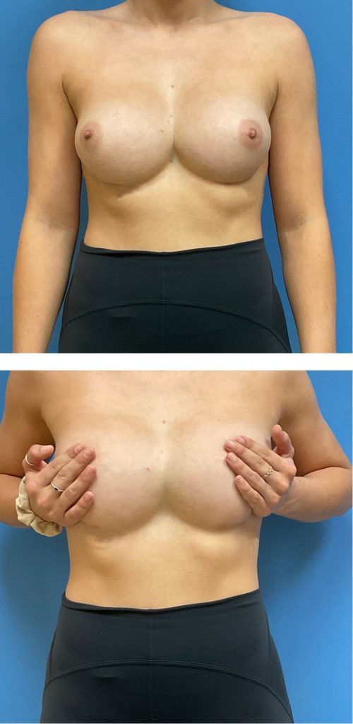 Before Symmastia Repair After Breast Augmentation