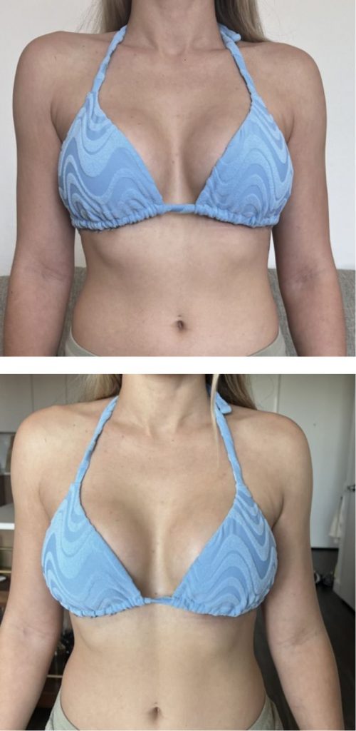 After Symmastia Repair After Breast Augmentation